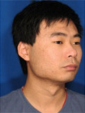 Patient # 36624 After Photo # 2